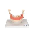 3B Scientific Dental disease - w/ 3B Smart Anatomy 1000016